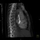 Osteoplastic skeletal metastases, breast carcinoma: CT - Computed tomography